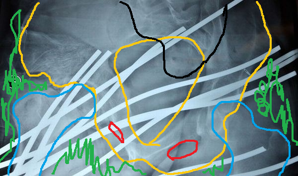 схематравмы1