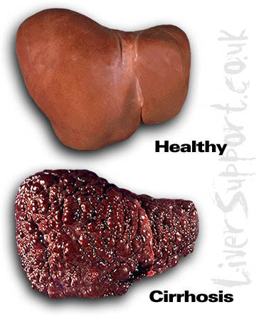 liver_cirrhosis
