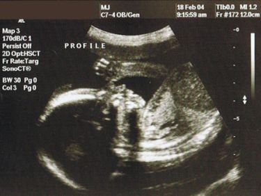 16a