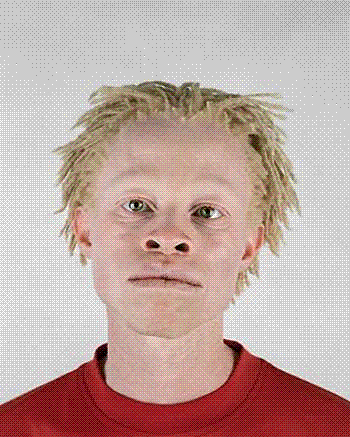 albino_african_americans