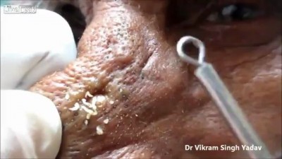 Угри и прыщи слишком много!