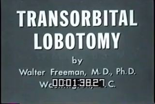 "Трансорбитальная лоботомия", ч.1, Уолтер Фримен