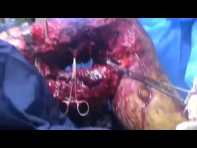 ЧЕЛОВЕК С УДИВИТЕЛЬНОЙ ТРАВМОЙ НОГИ