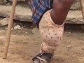 Indian Teen Has Football Sized Leg
